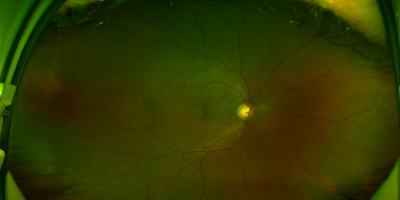 wide-field image of the retina