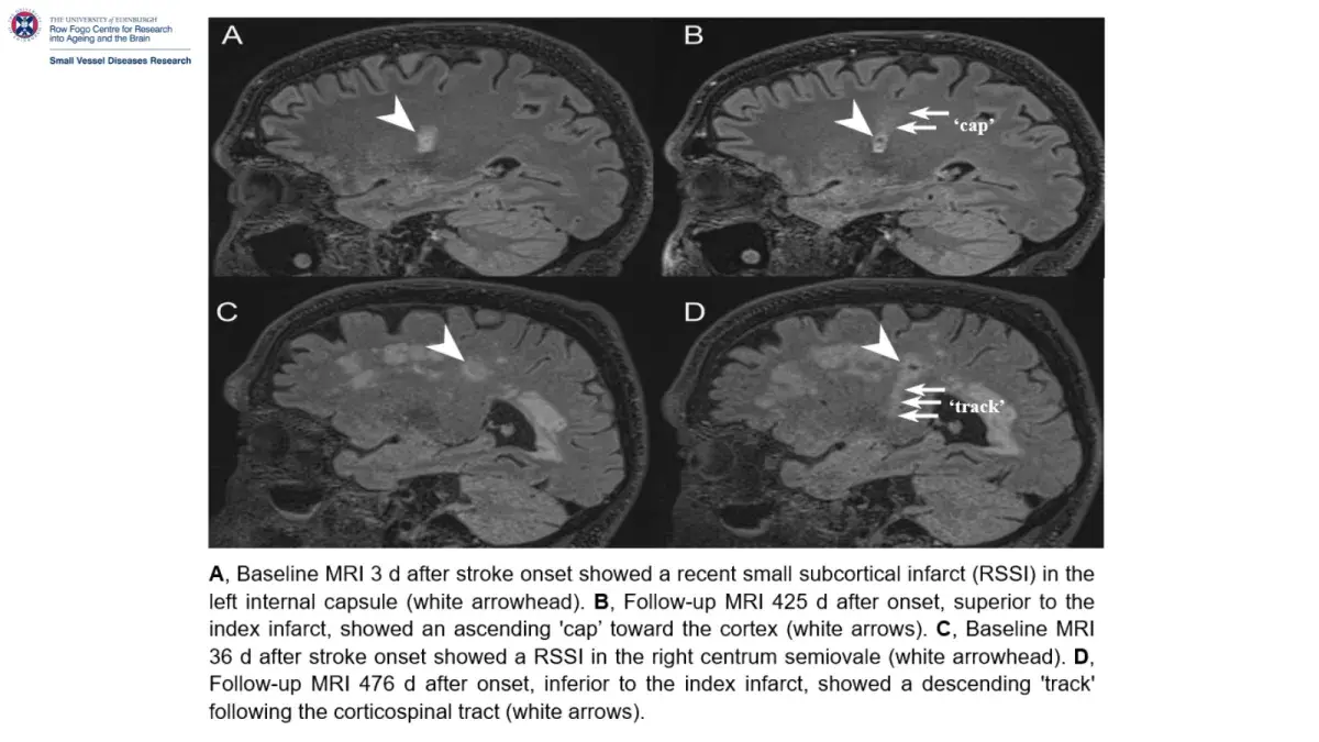 Black and white photograph of MRI images depicting 'caps' and 'tracks'