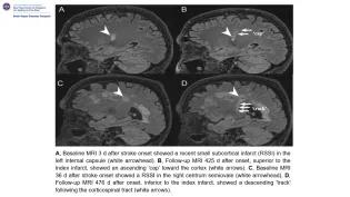 Black and white photograph of MRI images depicting 'caps' and 'tracks'