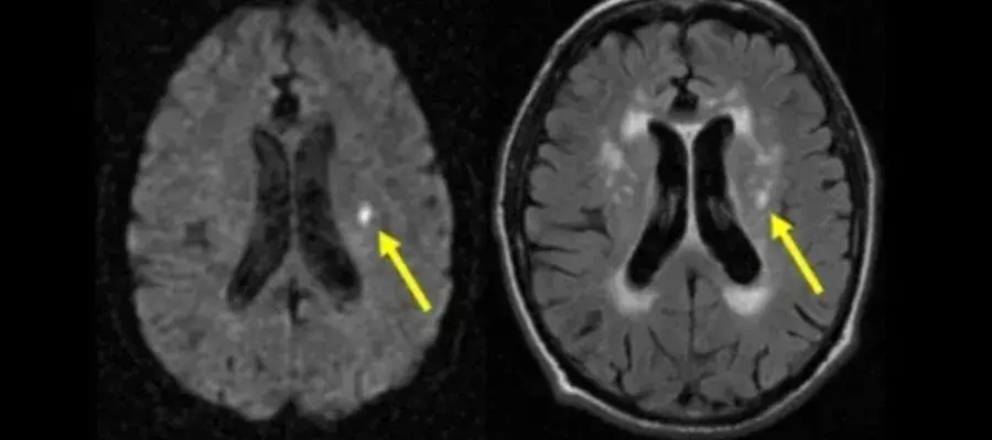 Black photo, two brain scans highlighting white matter hypertensities