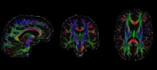 Black background, three colourful brain scans