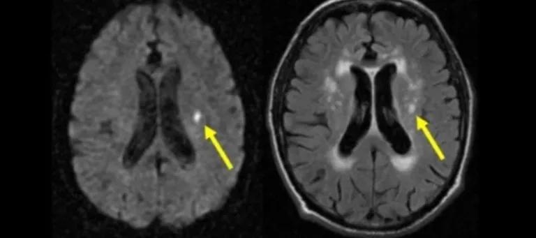 Black photo, two brain scans highlighting white matter hypertensities