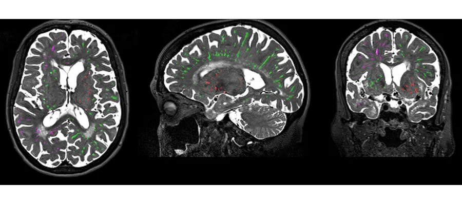 MRI brain scans