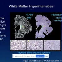 Dr Maria Valdes Hernandez discussing white matter hyperintensities