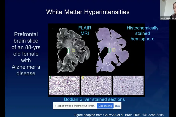 Dr Maria Valdes Hernandez discussing white matter hyperintensities