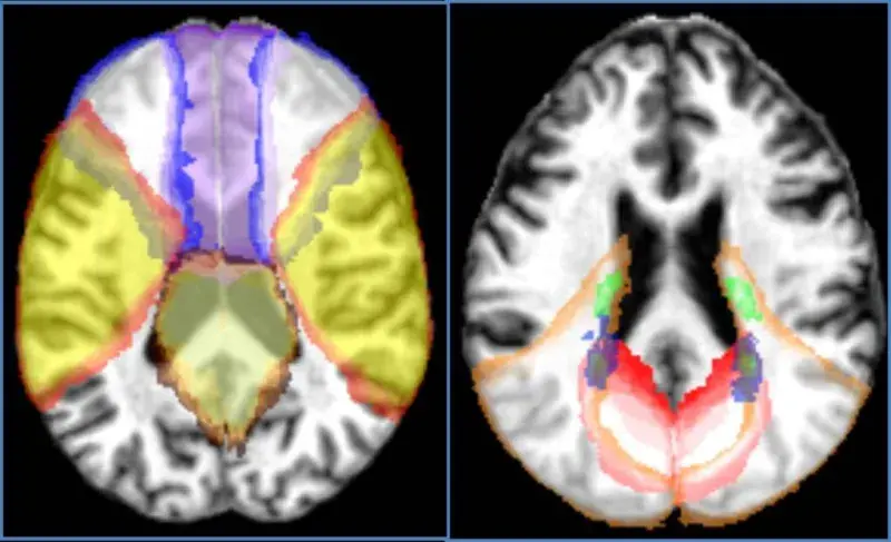Brain Arteries
