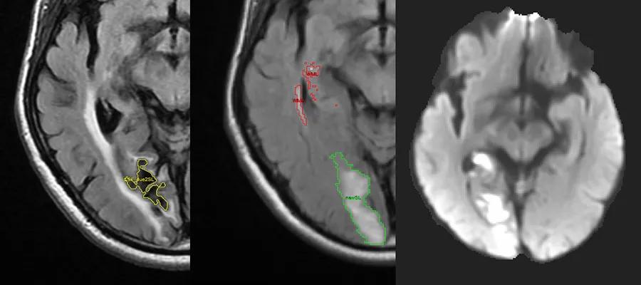 Brain_Stroke