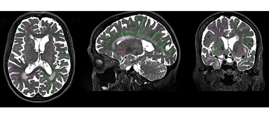 MRI brain scans